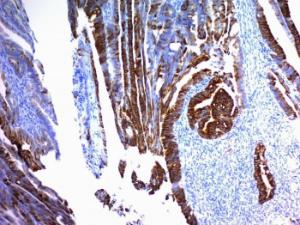 Immunohistochemical analysis of formalin-fixed, paraffin-embedded human colon carcinoma using Anti-MUC2 Antibody [SPM296]