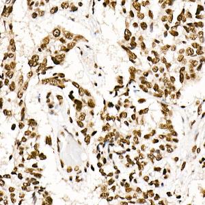 Immunohistochemistry analysis of paraffin-embedded human esophageal cancer using Anti-SF2 Antibody [ARC51453] (A306007) at a dilution of 1:100 (40X lens). Perform high pressure antigen retrieval with 10 mM citrate buffer pH 6.0 before commencing with IHC staining protocol