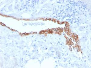 Immunohistochemical analysis of formalin-fixed, paraffin-embedded human lung mesothelioma using Anti-Mesothelin Antibody [MSLN/3384]