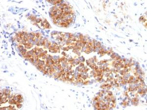 Immunohistochemical analysis of formalin-fixed, paraffin-embedded human breast carcinoma using Anti-MUC1 Antibody [MUC1/845]