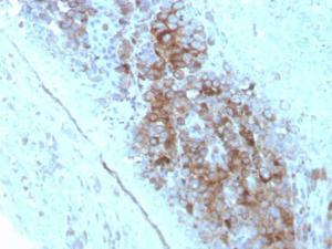 Immunohistochemical analysis of formalin-fixed, paraffin-embedded human melanoma using Anti-CD63 Antibody [LAMP3/2789]