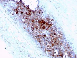 Immunohistochemical analysis of formalin-fixed, paraffin-embedded human melanoma using Anti-CD63 Antibody [LAMP3/2789]