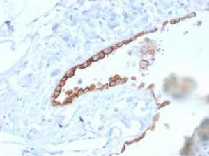 Immunohistochemical analysis of formalin-fixed, paraffin-embedded human lung mesothelioma using Anti-Mesothelin Antibody [MSLN/3384]