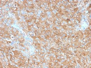 Immunohistochemical analysis of formalin-fixed, paraffin-embedded human prostate carcinoma using Anti-CD63 Antibody [LAMP3/2990R]