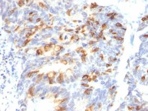 Immunohistochemical analysis of formalin-fixed, paraffin-embedded human colon carcinoma using Anti-MUC2 Antibody [MLP/842]