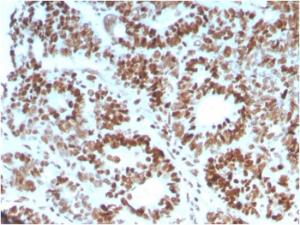 Immunohistochemical analysis of formalin-fixed, paraffin-embedded human colon carcinoma using Anti-MSH6 Antibody [MSH6/3086]