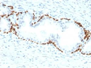 Immunohistochemical analysis of formalin-fixed, paraffin-embedded human prostate carcinoma using Anti-p63 Antibody [TP63/2428]