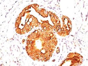 Immunohistochemical analysis of formalin-fixed, paraffin-embedded human breast carcinoma using Anti-MUC1 Antibody [MUC1/845]