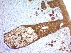 Immunohistochemical analysis of formalin-fixed, paraffin-embedded human skin using Anti-Keratin 76 Antibody [KRTH/1576R]