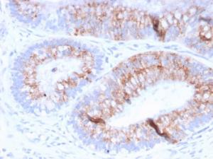 Immunohistochemical analysis of formalin-fixed, paraffin-embedded human colon carcinoma using Anti-MUC2 Antibody [MLP/842]