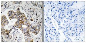 Immunohistochemical analysis of paraffin-embedded human breast carcinoma tissue using Anti-KCNK15 Antibody. The right hand panel represents a negative control, where the antibody was pre-incubated with the immunising peptide