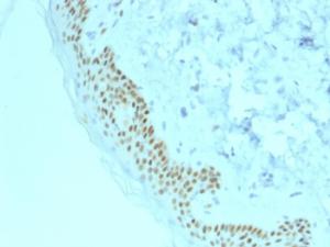 Immunohistochemical analysis of formalin-fixed, paraffin-embedded human basal cell carcinoma using Anti-p63 Antibody [TP63/2428]