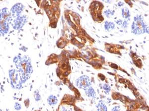 Immunohistochemical analysis of formalin-fixed, paraffin-embedded human breast carcinoma using Anti-MUC1 Antibody [MUC1/845]