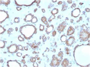 Immunohistochemical analysis of formalin-fixed, paraffin-embedded human thyroid using Anti-DBC2 Antibody [DBC2/3362]