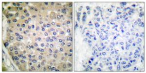 Immunohistochemical analysis of paraffin-embedded human breast carcinoma using Anti-CPI17 alpha (phospho Thr38) Antibody. The right hand panel represents a negative control, where the antibody was pre-incubated with the immunising peptide