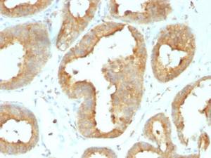 Immunohistochemical analysis of formalin-fixed, paraffin-embedded human breast carcinoma using Anti-GRP94 Antibody [9G10.F8.2]