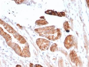 Immunohistochemical analysis of formalin-fixed, paraffin-embedded human breast carcinoma using Anti-FLT3 Antibody [FLT3/2458]