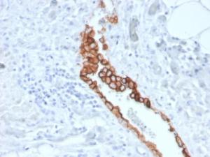 Immunohistochemical analysis of formalin-fixed, paraffin-embedded human mesothelioma using Anti-Mesothelin Antibody [MSLN/3387]