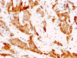 Immunohistochemical analysis of formalin-fixed, paraffin-embedded human breast carcinoma using Anti-GRP94 Antibody [9G10.F8.2]