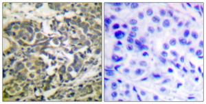 Immunohistochemical analysis of paraffin-embedded human breast carcinoma using Anti-AMPK alpha (phospho Thr172) Antibody. The right hand panel represents a negative control, where the antibody was pre-incubated with the immunising peptide.