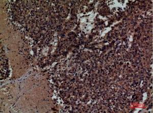 Immunohistochemical analysis of paraffin-embedded human lung cancer using Anti-KIR3DL3 Antibody