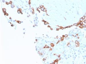 Immunohistochemical analysis of formalin-fixed, paraffin-embedded human mesothelioma using Anti-Mesothelin Antibody [MSLN/3387]