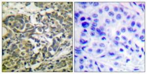 Immunohistochemical analysis of paraffin-embedded human breast cancer using Anti-AMPK alpha (phospho Thr172) Antibody 1:100 (4°C overnight). The right hand panel represents a negative control, where the antibody was pre-incubated with the immunising peptide.