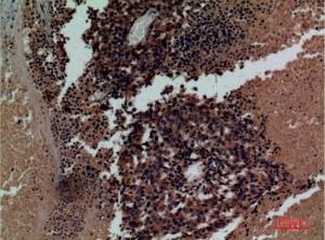 Immunohistochemical analysis of paraffin-embedded human lung cancer using Anti-KIR3DL3 Antibody