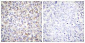 Immunohistochemical analysis of paraffin-embedded human breast cancer using Anti-AMPK alpha (phospho Thr172) Antibody 1:100 (4°C overnight). The right hand panel represents a negative control, where the antibody was pre-incubated with the immunising peptide.