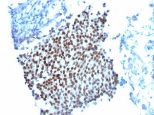 Immunohistochemical analysis of formalin-fixed, paraffin-embedded bladder carcinoma using Anti-p21 Antibody [WA-1]