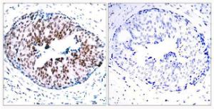 Immunohistochemical analysis of paraffin-embedded human breast carcinoma using Anti-STAT5A (phospho Ser780) Antibody. The right hand panel represents a negative control, where the antibody was pre-incubated with the immunising peptide