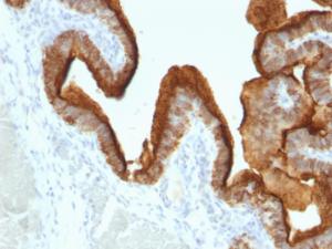 Immunohistochemical analysis of formalin-fixed, paraffin-embedded human ovarian carcinoma using Anti-MUC1 Antibody [SPM493]