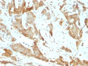 Immunohistochemical analysis of formalin-fixed, paraffin-embedded human breast carcinoma using Anti-GRP94 Antibody [SPM249]