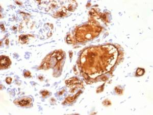 Immunohistochemical analysis of formalin-fixed, paraffin-embedded human breast carcinoma using Anti-MUC1 Antibody [115D8]