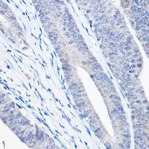 Immunohistochemistry analysis of paraffin-embedded human colon carcinoma tissue using Anti-Bax Antibody [ARC5006-10] (A306010) at a dilution of 1:20ï¼Œ1:50 (40X lens). Perform high pressure antigen retrieval with 10 mM citrate buffer pH 6.0 before commencing with IHC staining protocol