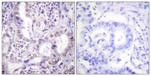 Immunohistochemical analysis of paraffin-embedded human lung carcinoma using Anti-Lys-Acetylated Proteins Antibody. The right hand panel represents a negative control, where the antibody was pre-incubated with the immunising peptide