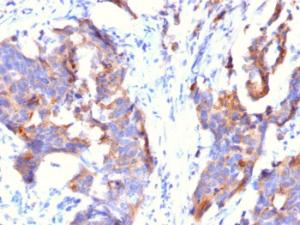 Immunohistochemical analysis of formalin-fixed, paraffin-embedded human stomach carcinoma using Anti-MUC1 Antibody [115D8]