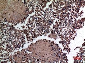 Immunohistochemical analysis of paraffin-embedded human lung cancer using Anti-HSPBAP1 Antibody