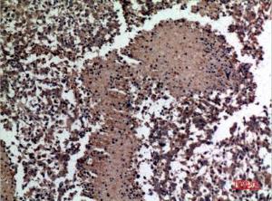 Immunohistochemical analysis of paraffin-embedded human lung cancer using Anti-HSPBAP1 Antibody