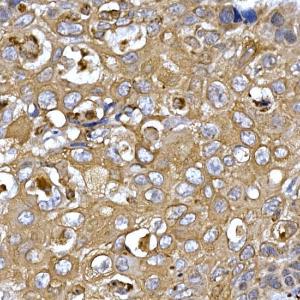 Immunohistochemistry analysis of paraffin-embedded human esophageal cancer using Anti-PPP1R3C Antibody (A307722) at a dilution of 1:50 (40X lens). Perform high pressure antigen retrieval with 10 mM citrate buffer pH 6.0 before commencing with IHC staining protocol