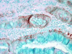 Immunohistochemistry analysis of human colon carcinoma, fixed in formalin