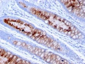 Immunohistochemical analysis of formalin-fixed, paraffin-embedded human colon carcinoma using Anti-MUC4 Antibody [MUC4/3105]