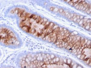 Immunohistochemical analysis of formalin-fixed, paraffin-embedded human colon carcinoma using Anti-MUC4 Antibody [MUC4/3105]