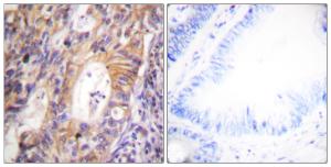 Immunohistochemical analysis of paraffin-embedded human colon carcinoma using Anti-c-Met (phospho Tyr1003) Antibody. The right hand panel represents a negative control, where the antibody was pre-incubated with the immunising peptide.