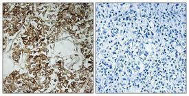 Immunohistochemical analysis of paraffin-embedded human breast cancer using Anti-HLA-DOA Antibody 1:100 (4°C overnight). The right hand panel represents a negative control, where the antibody was pre-incubated with the immunising peptide.