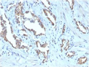 Immunohistochemical analysis of formalin-fixed, paraffin-embedded human prostate carcinoma using Anti-TIGIT Antibody [TIGIT/3106] (Biotin)