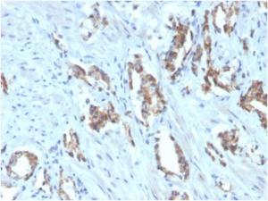 Immunohistochemical analysis of formalin-fixed, paraffin-embedded human prostate carcinoma using Anti-TIGIT Antibody [TIGIT/3106] (Biotin)