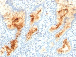 Immunohistochemical analysis of formalin-fixed, paraffin-embedded human gastric carcinoma using Anti-MUC4 Antibody [MUC4/3105]