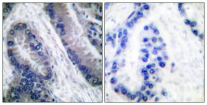 Immunohistochemical analysis of paraffin-embedded human lung carcinoma using Anti-IL-1 beta (cleaved Asp210) Antibody. The right hand panel represents a negative control, where the antibody was pre-incubated with the immunising peptide.