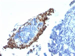 Immunohistochemical analysis of formalin-fixed, paraffin-embedded bladder carcinoma using Anti-p21 Antibody [HJ21]